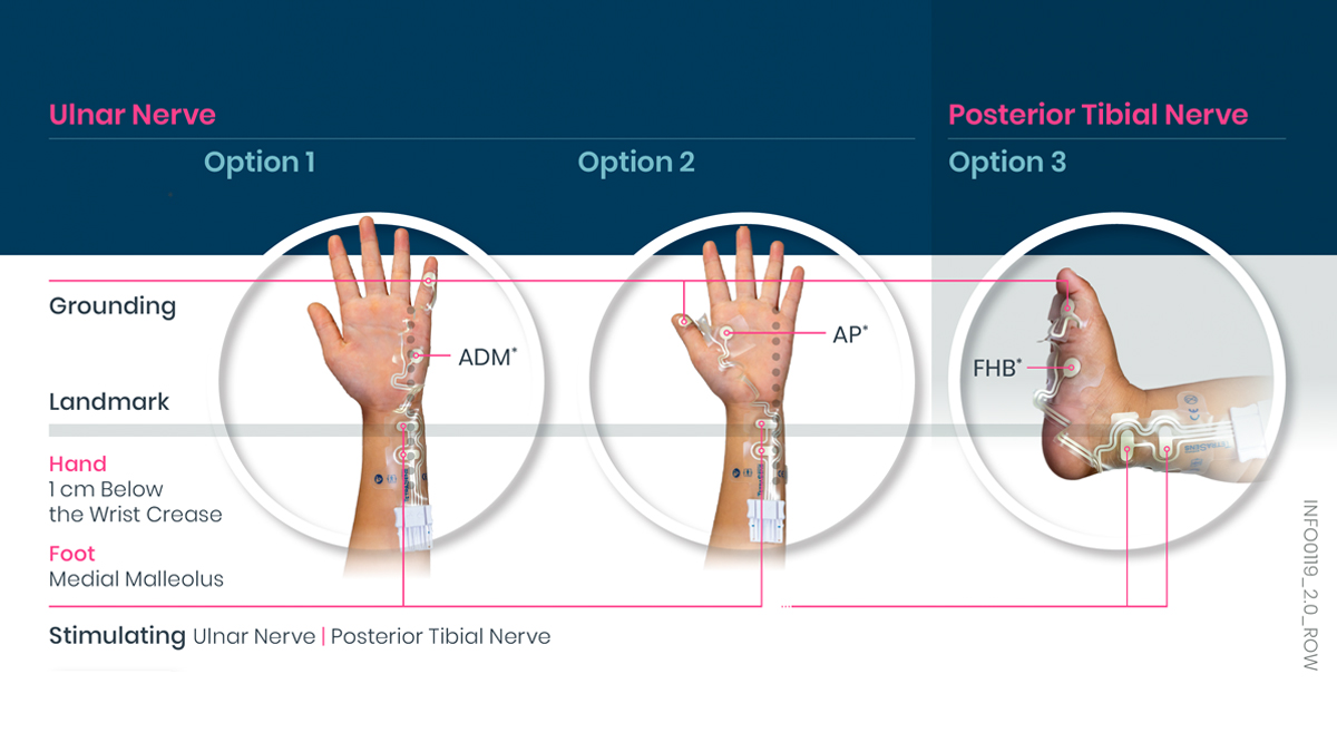 Diagram som visar elektrodplaceringar för ulnar- och bakre tibialnervstimulering på hand och fot.