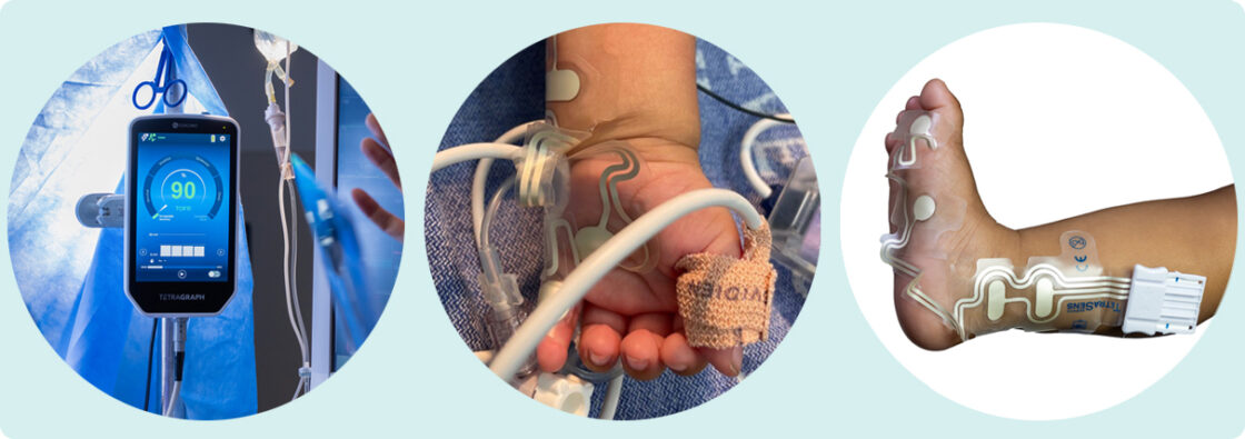 Tre cirkelformade bilder visar medicinsk utrustning på arm, hand och fot hos en patient på sjukhus.